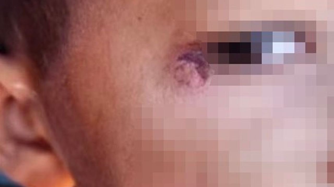 Şanlıurfa'da temizlik görevlisi öğrencinin yüzünde sigara söndürdü!