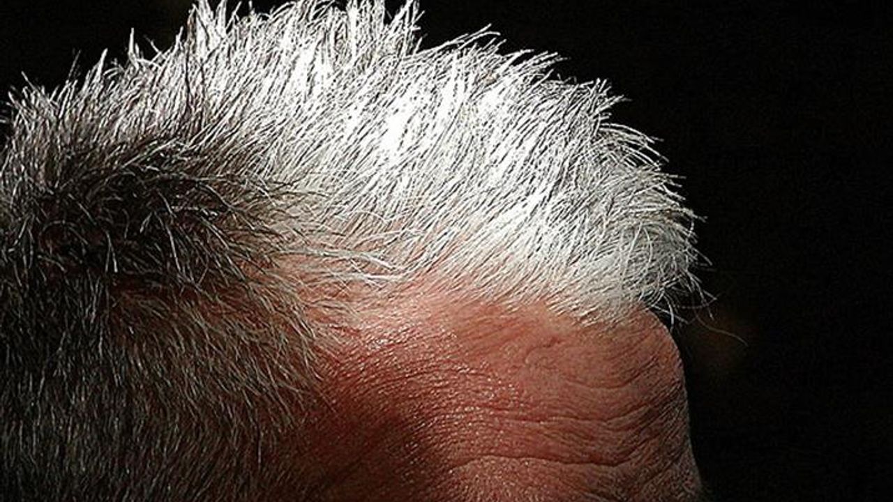 Bilim İnsanları Açıklıyor: Saç Beyazlaması Kanseri Önleyebilir mi?