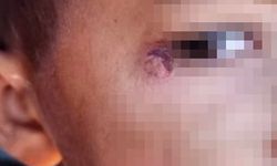 Şanlıurfa'da temizlik görevlisi öğrencinin yüzünde sigara söndürdü!