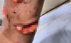 Köpek Saldırısında Küçük Çocuğun Vücuduna 150 Dikiş Atıldı...