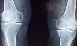 Malatya’da Diz Ve Kalça Protezi Ameliyatları Sonrası Enfeksiyon Riskine Dikkat!