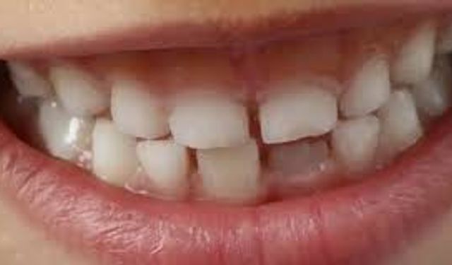 Çocuklarda Diş Sıkma Alışkanlığı: Baş Ağrısı ve Diğer Belirtilere Dikkat!