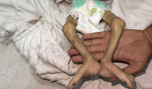 İsrail'in kıtlığı dayattığı Gazze'de bir bebek daha açlıktan can verdi