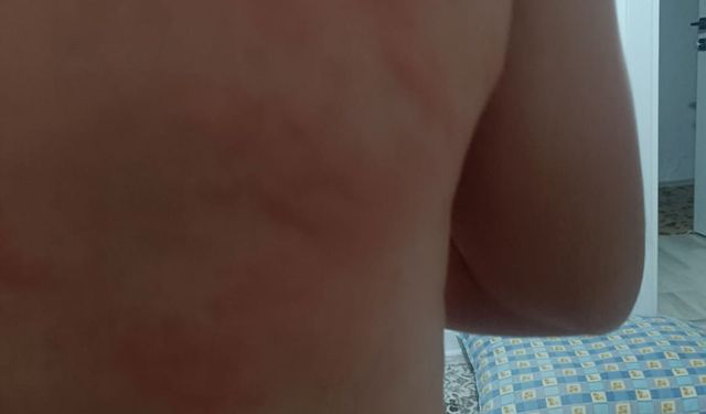 Elazığ’da böcek ısırığı hastanelik etti