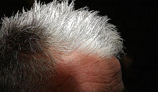 Bilim İnsanları Açıklıyor: Saç Beyazlaması Kanseri Önleyebilir mi?