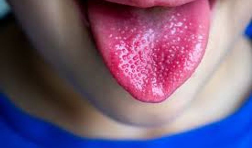 Dil rengi ve dokusu sağlık sorunlarının habercisi olabilir