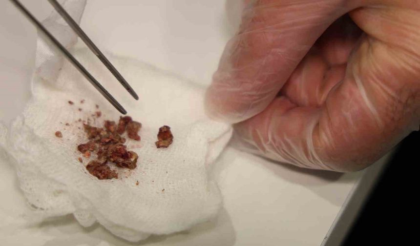 Elazığ'da estetik ameliyatta şaşırtan olay, burundan taş çıktı